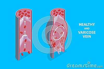 3D Isometric Flat Vector Illustration of Healthy And Varicose Vein Vector Illustration