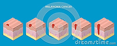 3D Isometric Flat Vector Illustration of Melanoma Cancer Vector Illustration