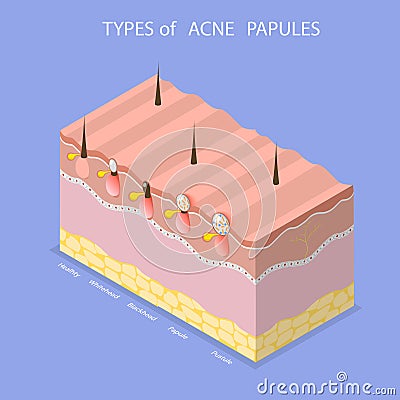 3D Isometric Flat Vector Illustration of Types Of Acne Papules Vector Illustration