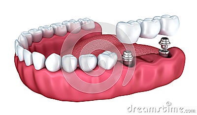 3d lower teeth and dental implant isolated Stock Photo