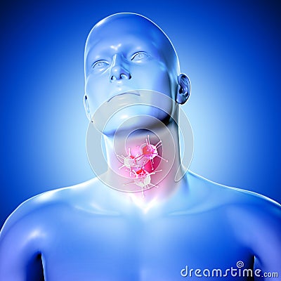 3d medical figure with virus cells on sore throat Stock Photo