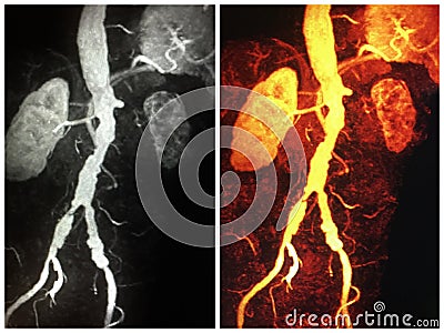 3d mra atrophic kidney ectatic iliac arteries thrombus Stock Photo