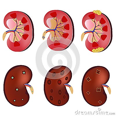 3D Realistic anatomy vector set kidney, normal kidney, kidney infection, sick kidney. Anatomy human. Medicine concept Vector Illustration