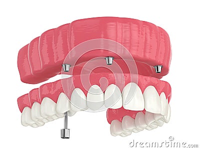 3d render of all on 4 dental implants treatment Stock Photo