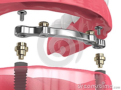 3d render of bar retained removable overdenture installation supported by two implants Stock Photo