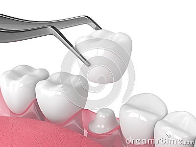 3d render of crown replacement on reshaped tooth Stock Photo