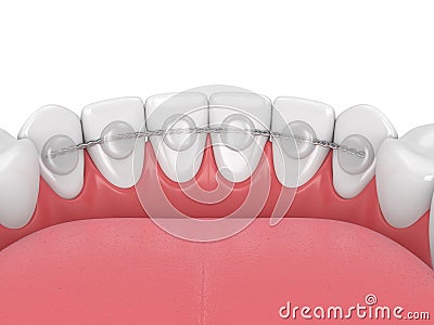 3d render of dental bonded retainer on lower jaw Stock Photo