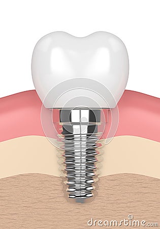 3d render of dental implant in gums Stock Photo