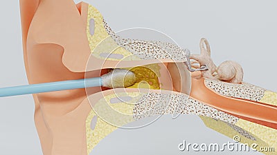 3d render ear cleansing earwax ear stick. 3d illustration Stock Photo