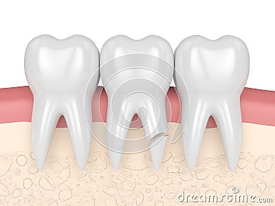 3d render of gums with cracked tooth root Stock Photo
