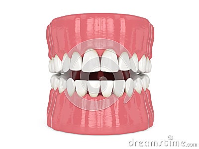 3d render of human jaw with black triangles Stock Photo
