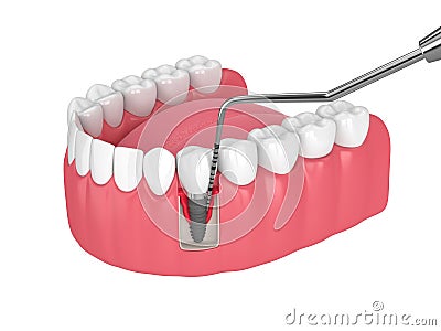 3d render of human jaw with peri implantitis disease and periodontal sonda Stock Photo
