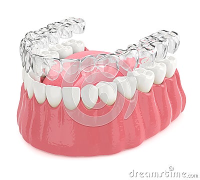 3d render of invisalign removable retainer with lower jaw Stock Photo