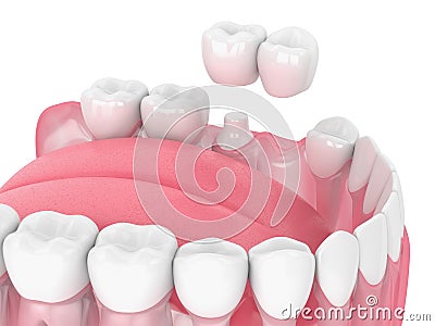 3d render of jaw with cantilever bridge Stock Photo