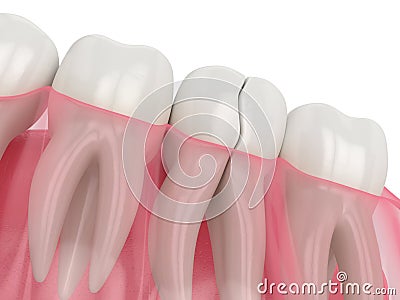 3d render of jaw with cracked tooth Stock Photo