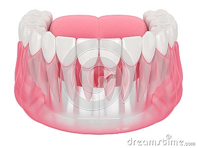 3d render of jaw with cracked tooth root Stock Photo