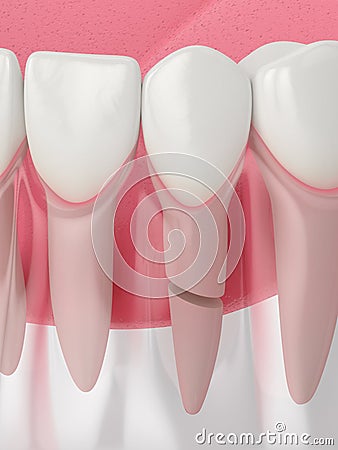 3d render of jaw with cracked tooth root Stock Photo