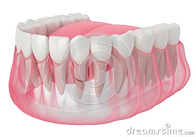 3d render of jaw with cracked tooth root Stock Photo