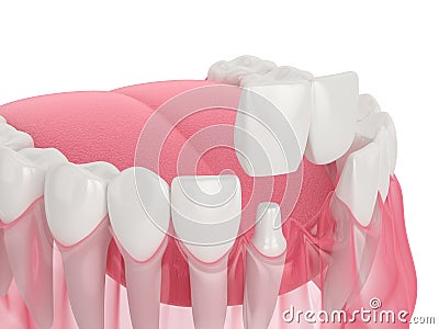 3d render of jaw with dental cantilever bridge Stock Photo