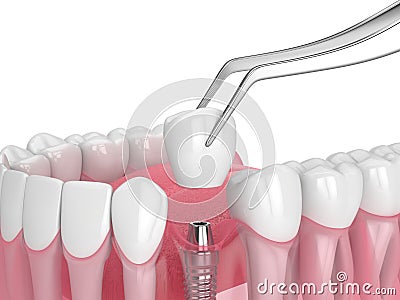 3d render of jaw with dental implant placement Stock Photo