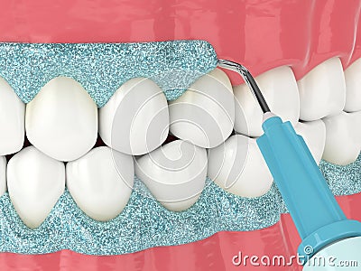 3d render of jaw with gingival mask before teeth bleaching Stock Photo