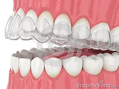 3d render of jaw with invisalign removable retainer Stock Photo