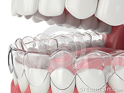 3d render of jaw with invisalign removable retainer Stock Photo