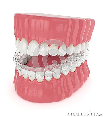 3d render of jaw with invisalign removable retainer Stock Photo