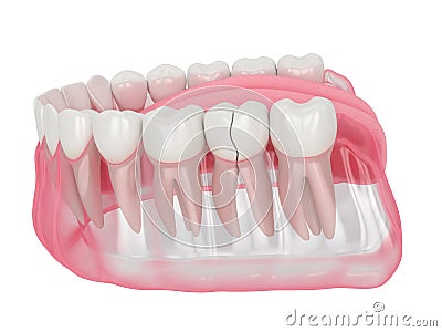 3d render of jaw with cracked tooth Stock Photo