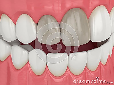 3d render of jaw and teeth with dead pulp Stock Photo
