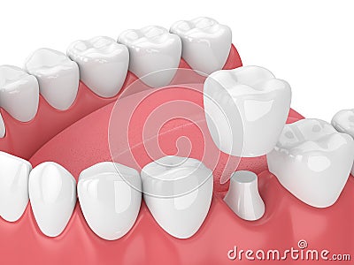 3d render of jaw with teeth and dental crown restoration Stock Photo