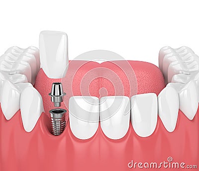 3d render of jaw with teeth and dental incisor implant Stock Photo