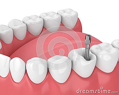 3d render of jaw with teeth and dental metal post Stock Photo