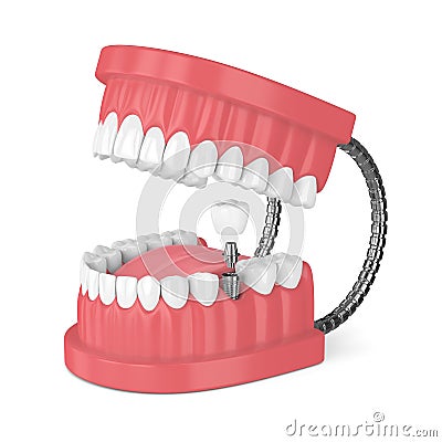 3d render of jaw with teeth and dental molar implant Stock Photo