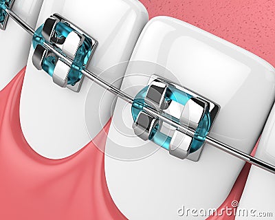 3d render of jaw with teeth and orthodontic braces Stock Photo