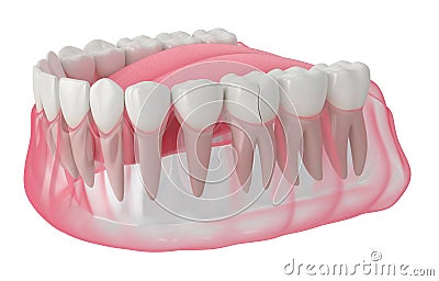3d render of jaw with cracked tooth Stock Photo