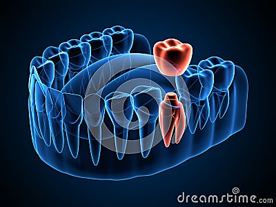 3d render of jaw x-ray with dental crown embed on tooth Stock Photo