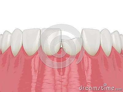 3d render of lower jaw with broken incisor tooth Stock Photo