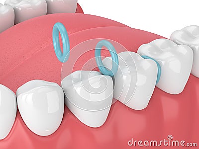 3d render of rubber separators between teeth Stock Photo