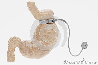3D Render of Stomach with Gastric Band Stock Photo