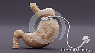 3D Render of Stomach with Gastric Band Stock Photo