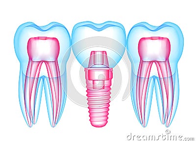 3d render of teeth with dental implant over white Stock Photo