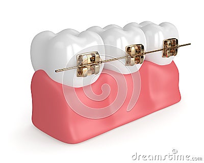 3d render of teeth with golden orthodontic braces Stock Photo