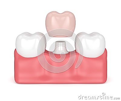 3d render of teeth with dental crown restoration Stock Photo