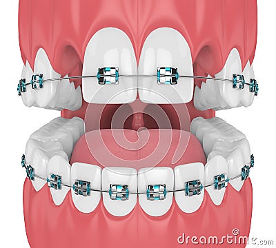 3d render of teeth with orthodontic braces and cavities Stock Photo