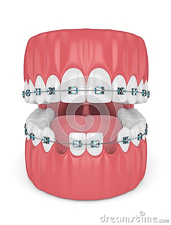 3d render of teeth with orthodontic braces and cavities Stock Photo