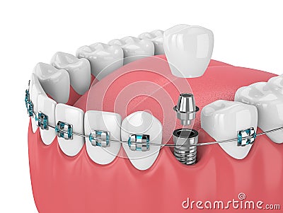 3d render of teeth with orthodontic braces and dental implants Stock Photo