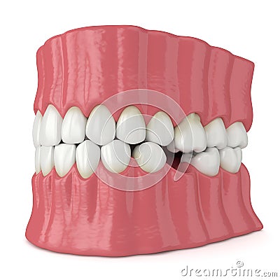 3d render of teeth sliding towards the area of missing tooth in order to fill the gap Stock Photo