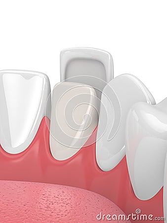 3d render of teeth with veneer Stock Photo