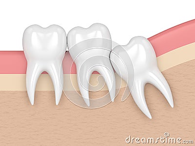 3d render of teeth with wisdom crowding Stock Photo